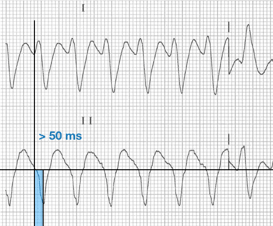 R-Wave Peak Time (RWPT) Lead II negative