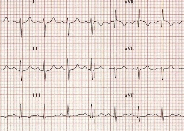 RAD due to RVH Axis Example 002