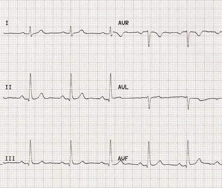 ECG Leads Baseline ECG
