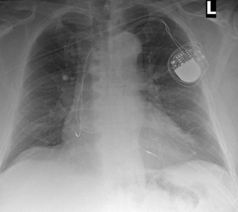 ECG Case 111 AP CXR Post PPM