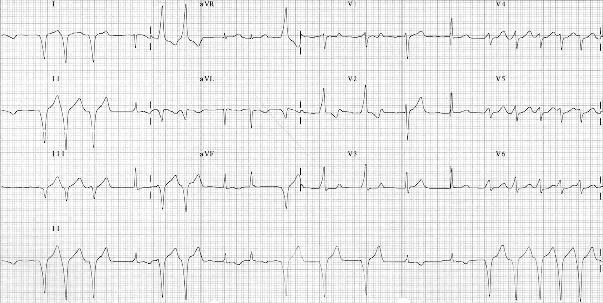 ECG WPW with intermittent pre-excitation 2