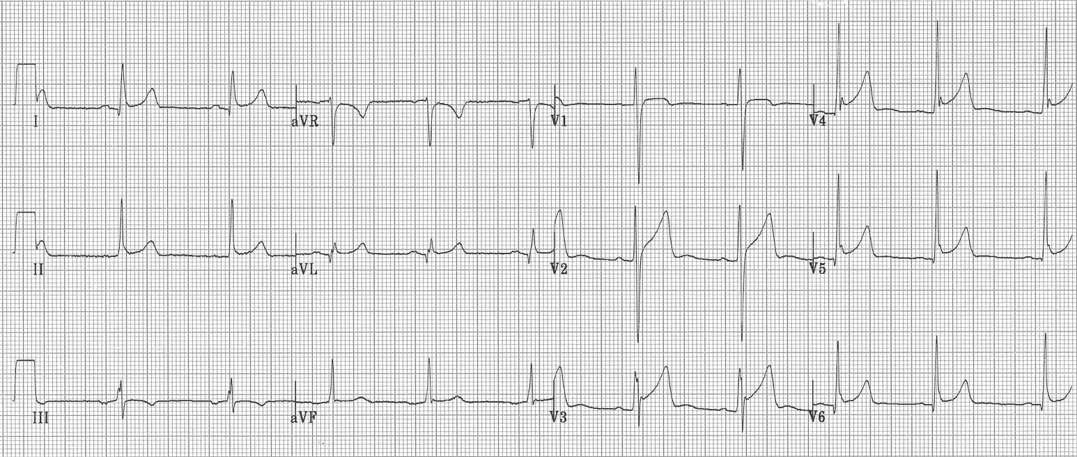 ECG pericarditis-or-BER