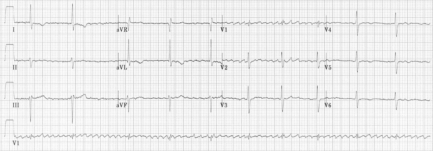 regularised atrial fibrillation ECG