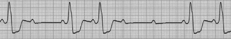 ECG Rhythm strip Mobitz II