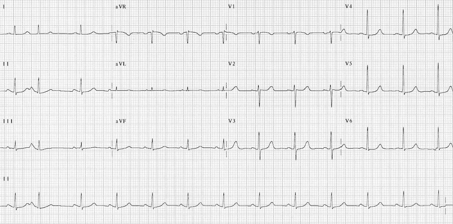 Fast-Slow-AVNRT resolved 4b 2