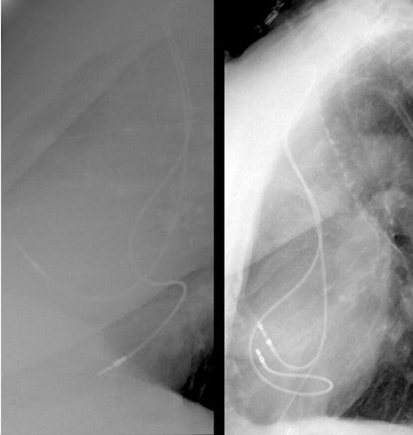 ECG Case 111 Lat cardiac comparison