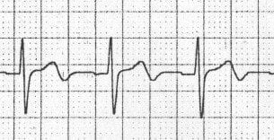 Biphasic T waves due to ischaemia