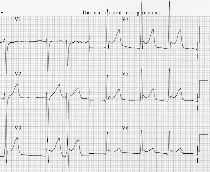 J waves Osborn Wave hypothermia temp 30°C