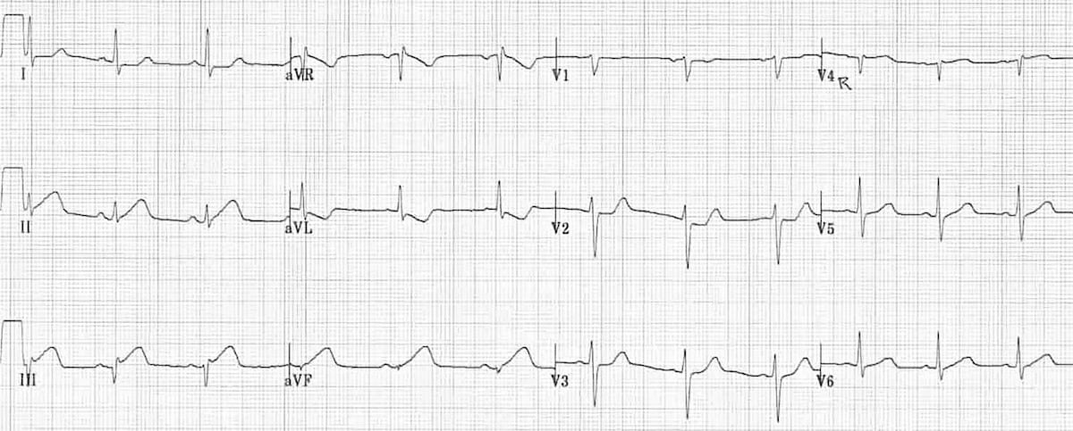 ECG Inferior STEMI Hyperacute 1