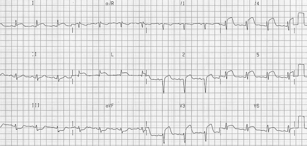 ECG Extensive Anterolateral STEMI