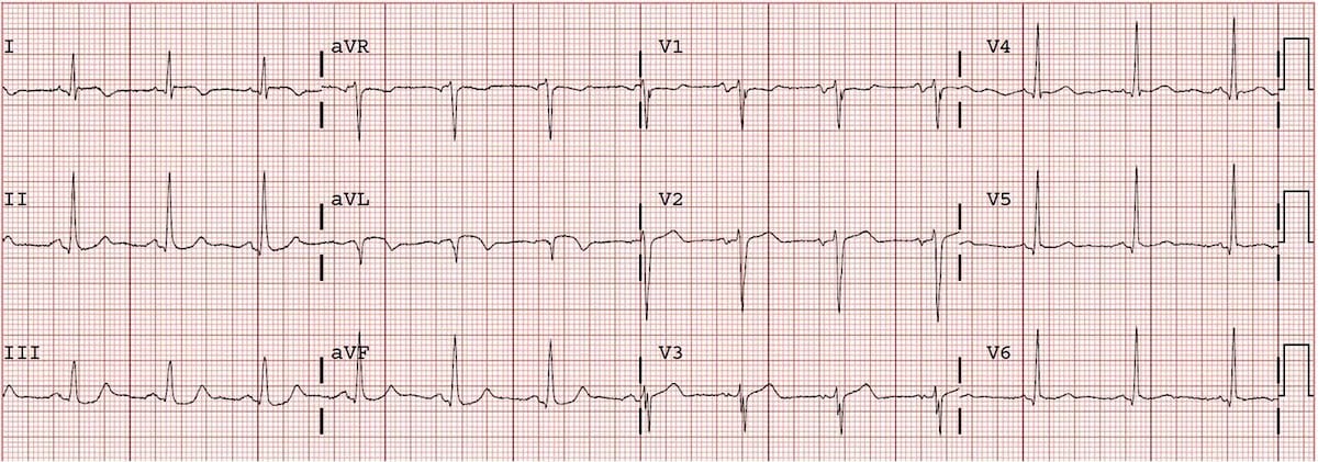 ECG Completed high lateral AMI