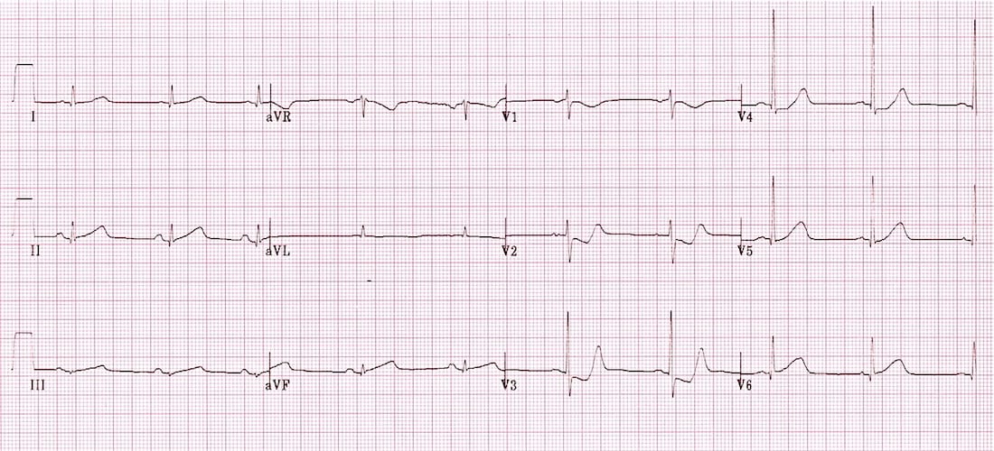ECG Posterior AMI 3
