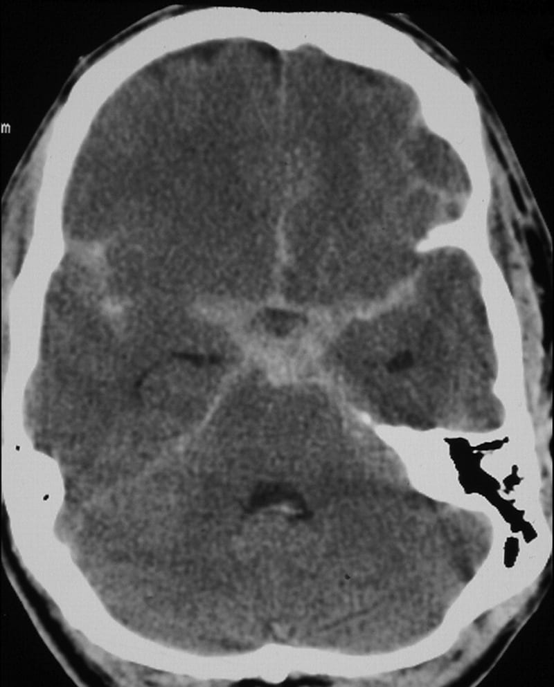 Subarachnoid haemorrhage SAH on CT