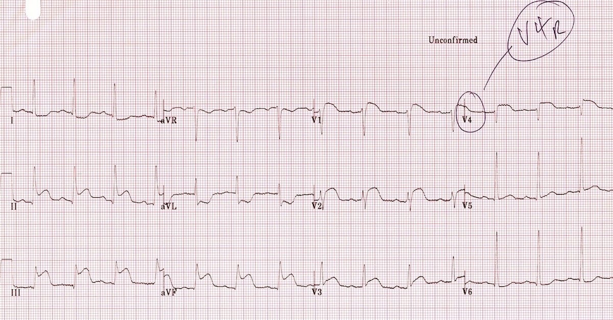 ECG Right ventricular infarction 1b V4R