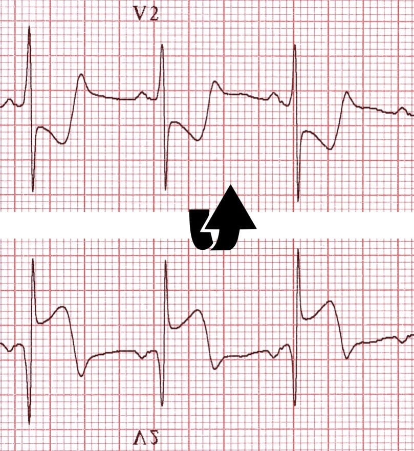 ECG Posterior AMI flip image V2 2