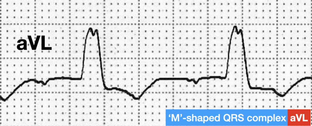 LBBB QRS morphology 'M'-shaped