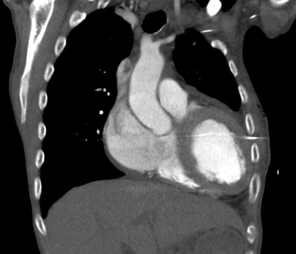 Chest drain intra cardiac c2