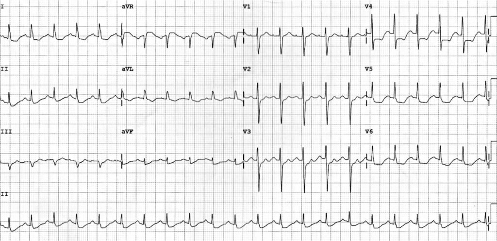 ECG Left main coronary artery (LMCA) 1
