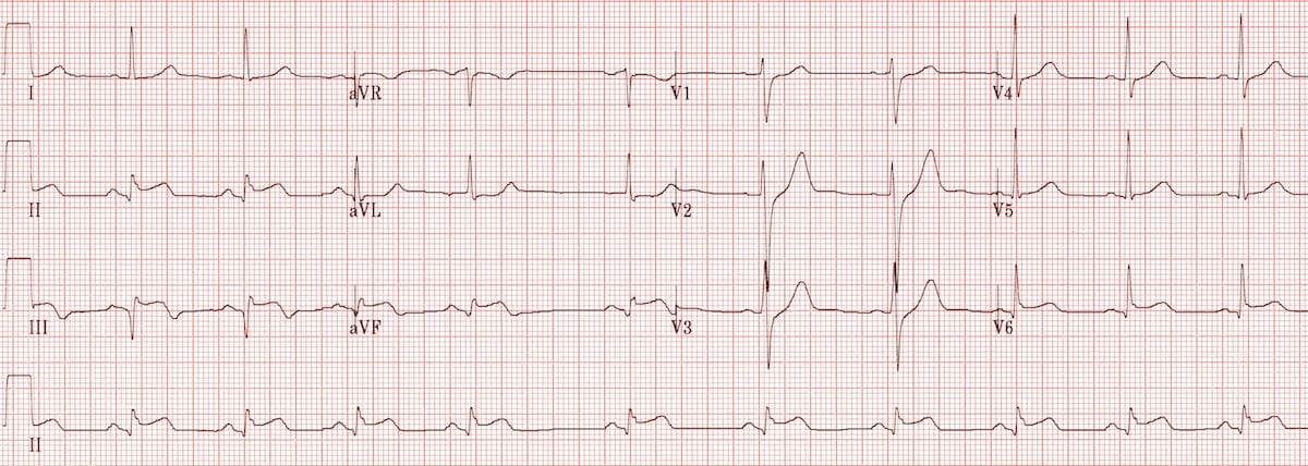 ECG Recent inferolateral STEMI