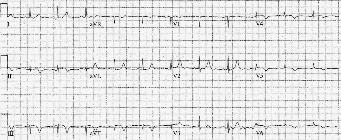 ECG Case 081c LITFL Top 100 EKG
