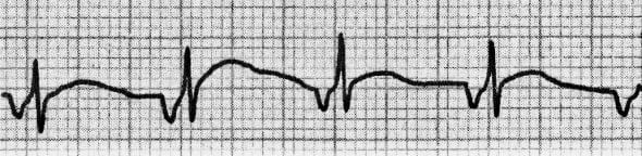 ECG AJR 2