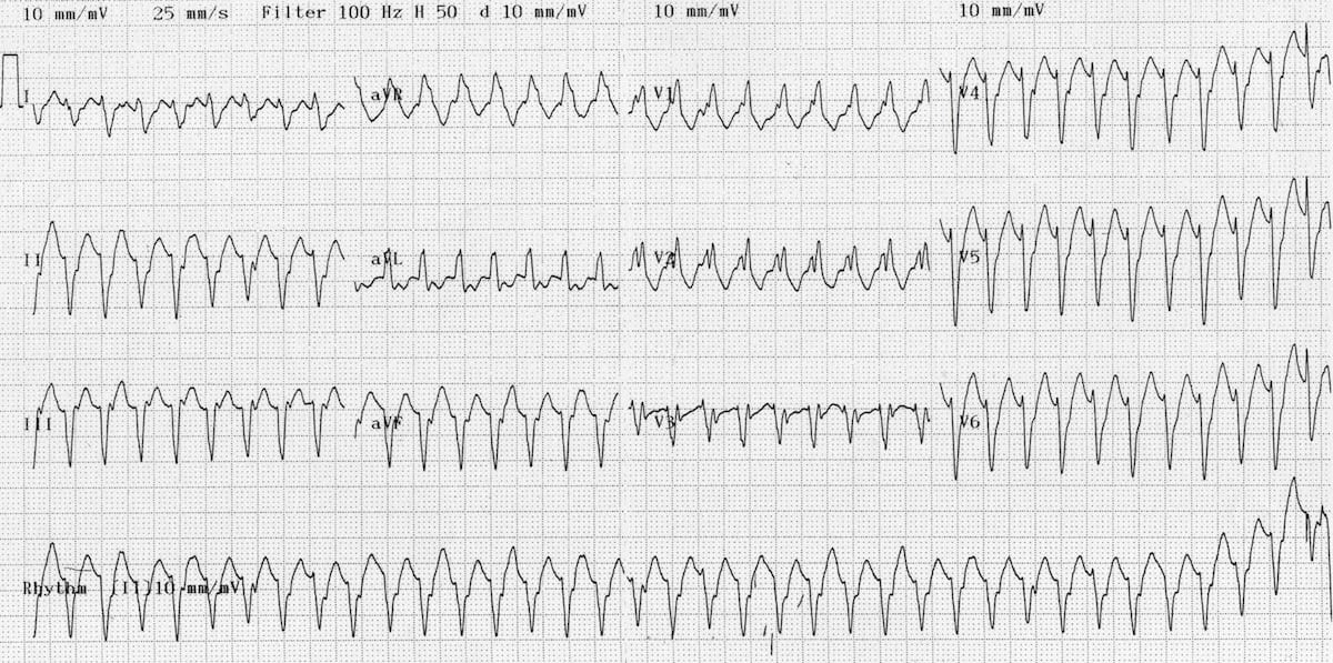 ECG Ventricualr tachycardia Monomorphic VT