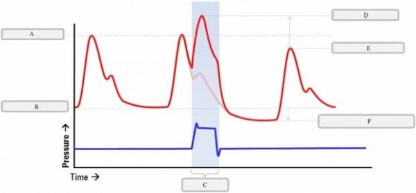 IABP Wafeforms unalbelled