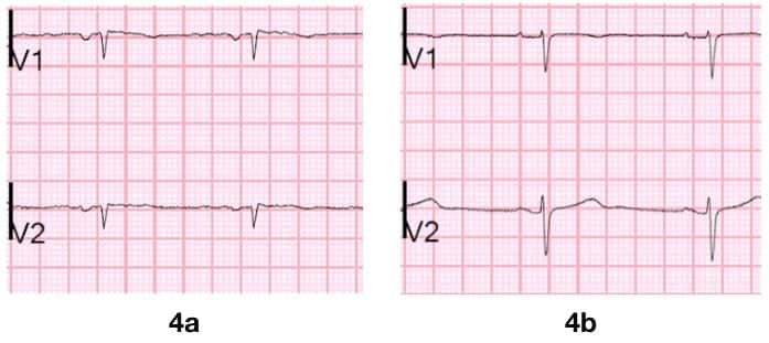 Figure 4 Old septal MI q waves Smith S