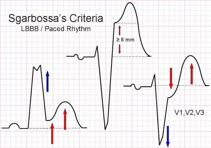 Sgarbossa criteria LBBB Paced rhythm