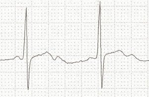 Prominent U waves due to severe hypokalaemia