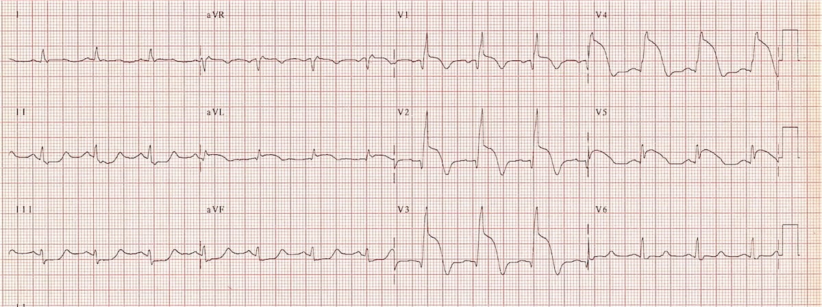 ECG Proximal LAD Acute anteroseptal STEMI