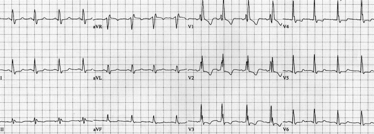 ECG LMCA GI bleed Baseline