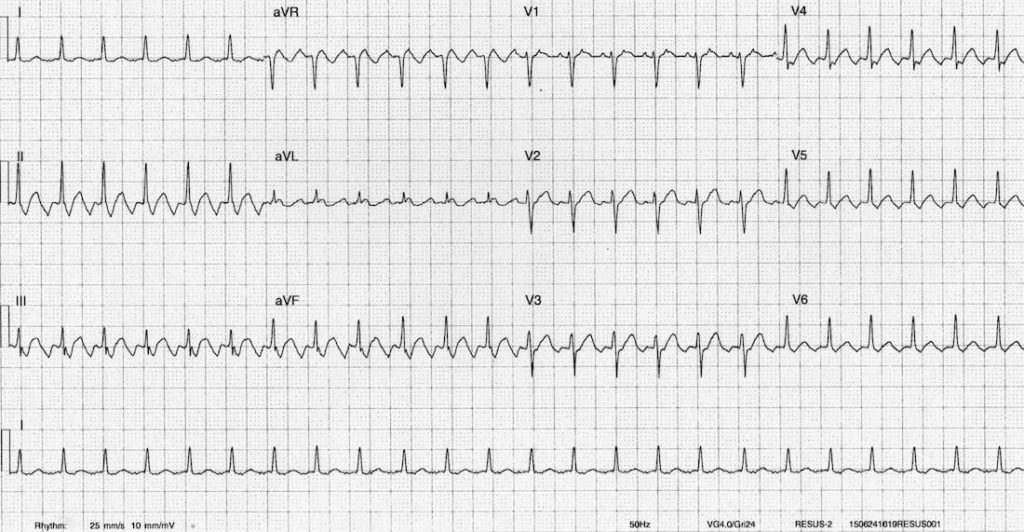 TOP 100 ECG QUIZ LITFL 042 2