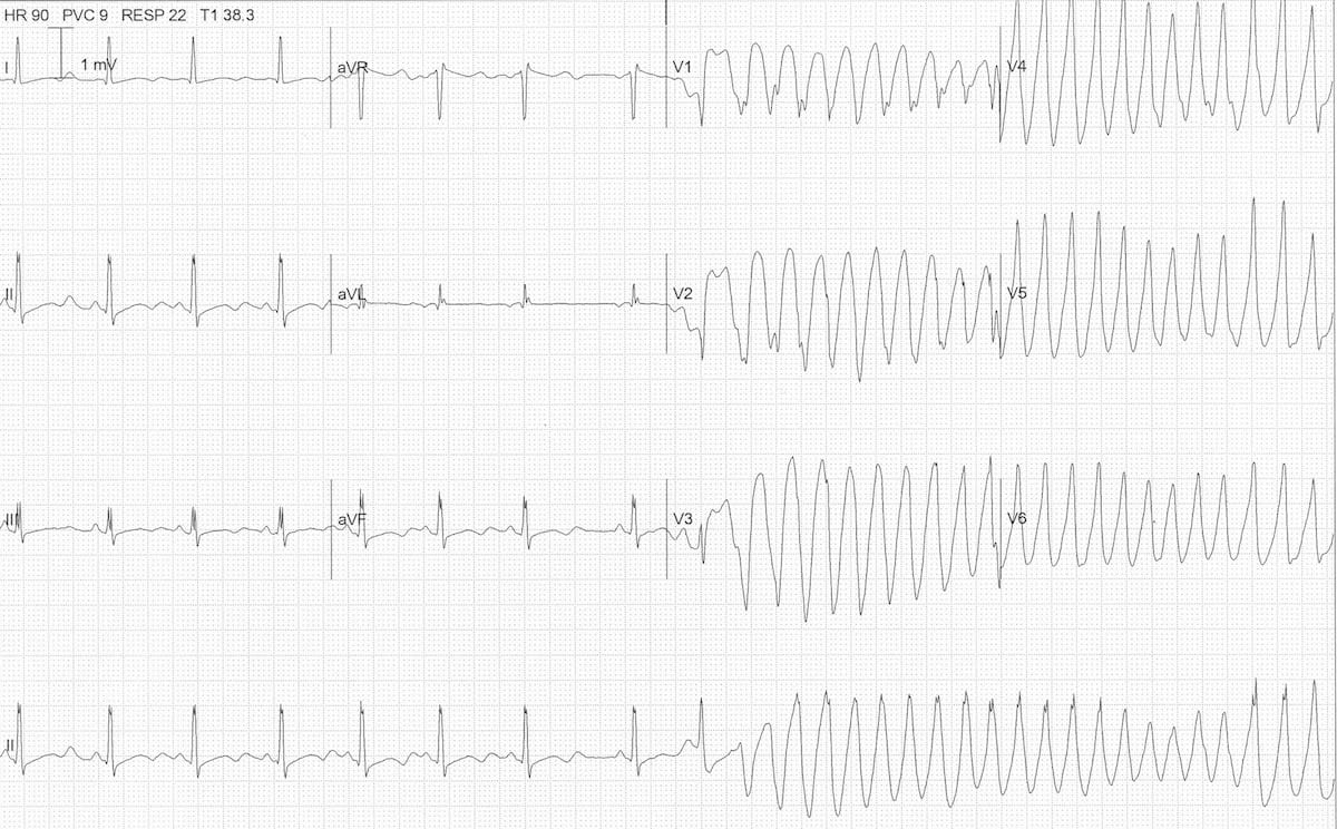 ECG hypokalaemia torsades 2