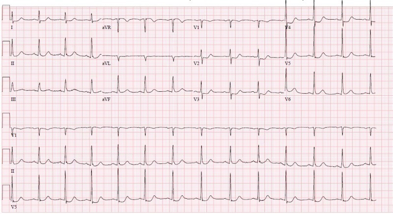 OMI ECG Posterior Myocardial Ischaemia