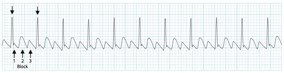Atrial flutter with a 3-1 block