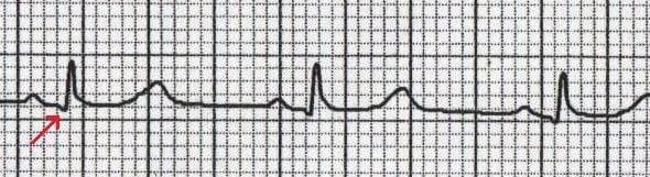 Normal Q wave in V6