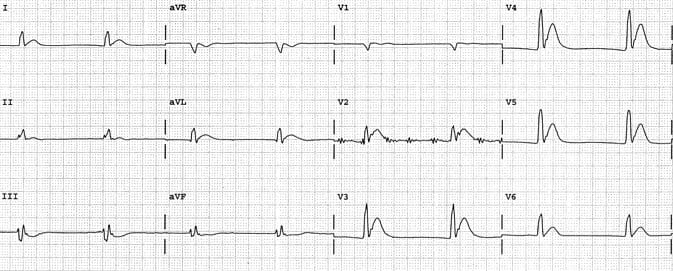 ECG Short QT Hypercalcaemiaa
