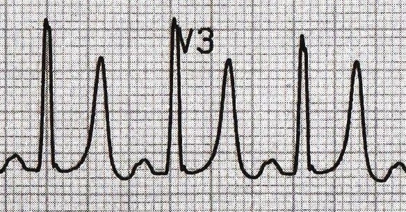 ECG Peaked T waves hyperkalemia