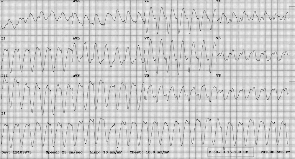 TOP 100 ECG QUIZ LITFL 047