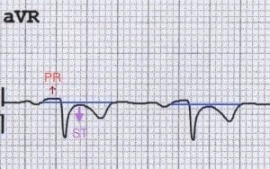 avr-pericarditis