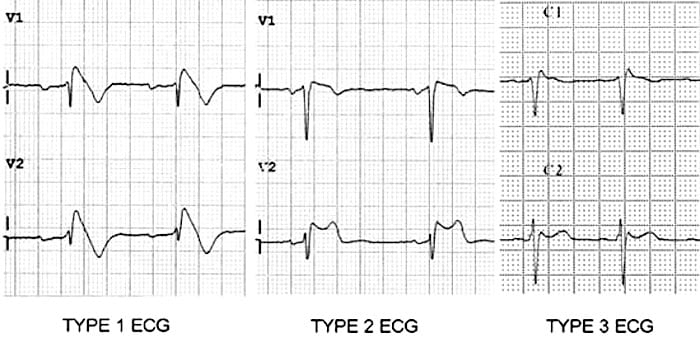 Brugada syndrome type 1 2 3