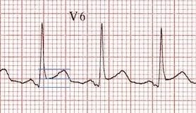 ST-segment-T-wave-ratio-pericarditis