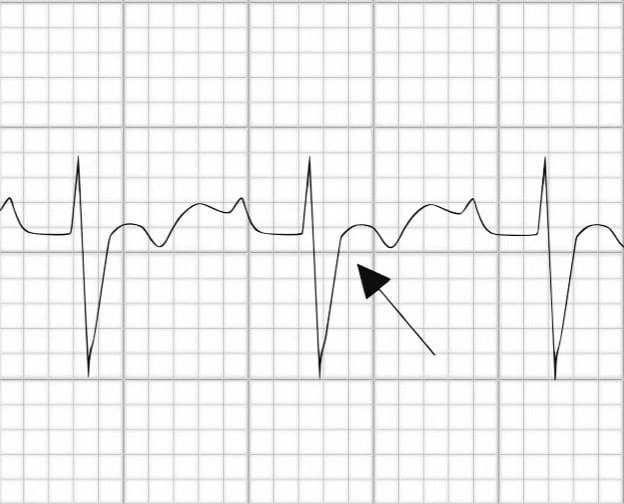Prolonged S-wave upstroke in ARVD