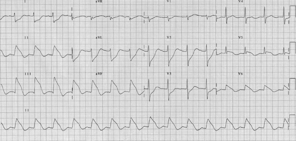 TOP 100 ECG QUIZ LITFL 039 2