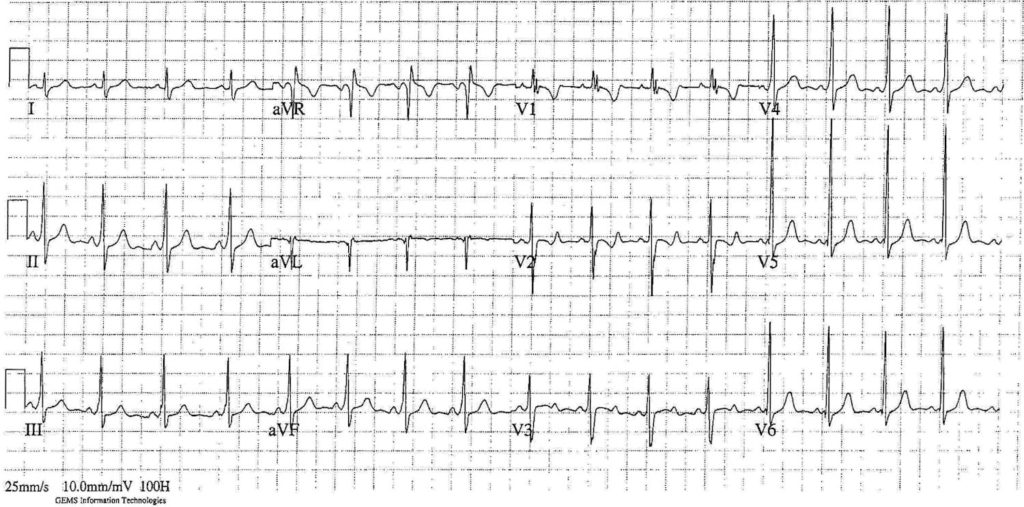 ECG Case 073 Top 100