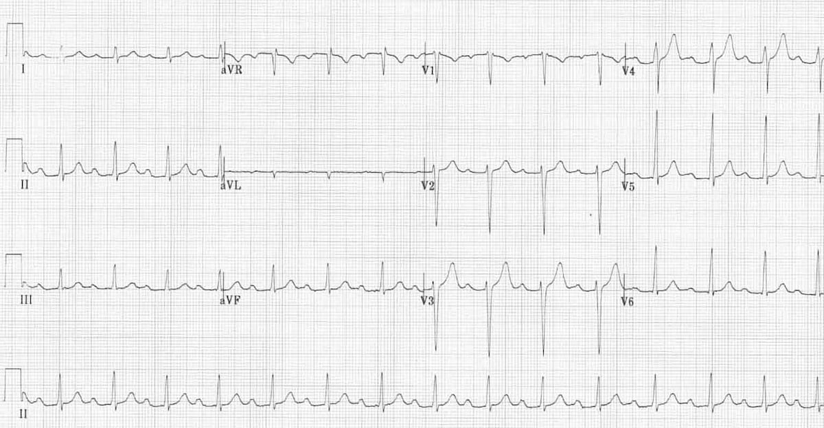 ECG 1st degree AV block 2