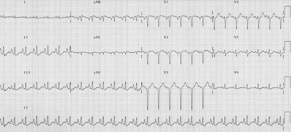 TOP 100 ECG QUIZ LITFL 021