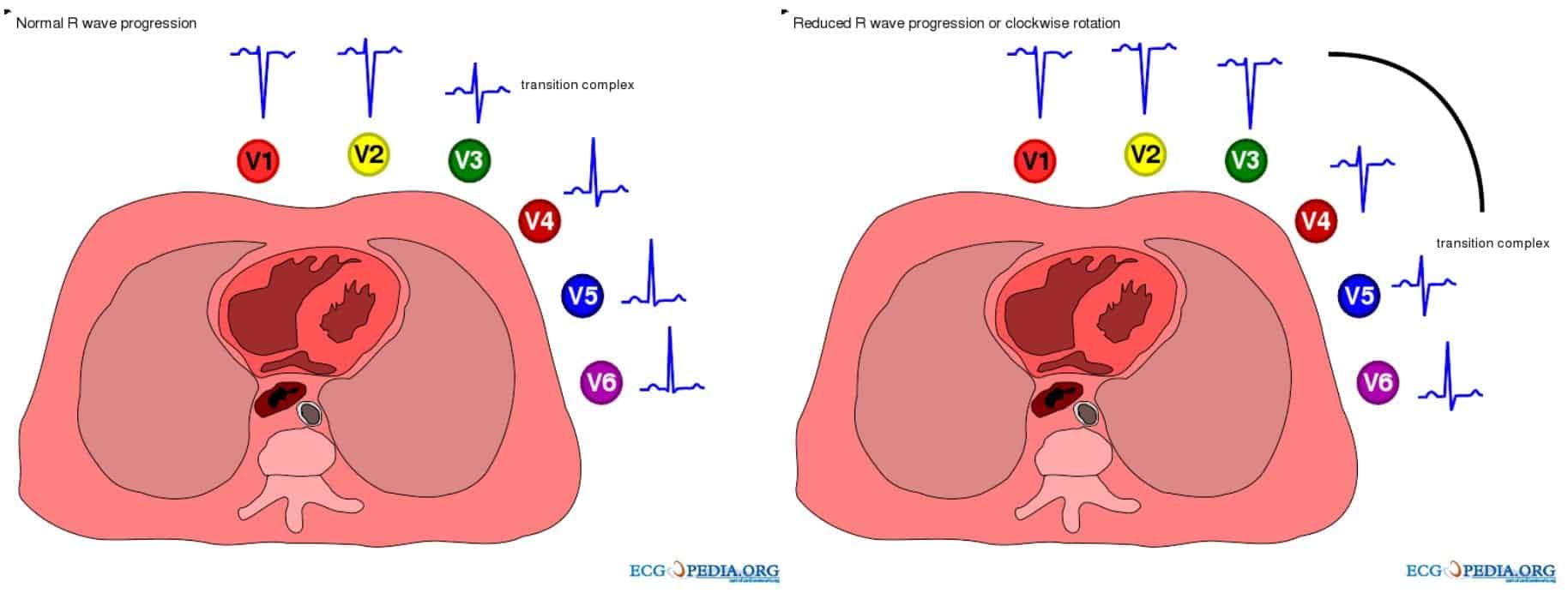 R-wave-progression-COPD-1