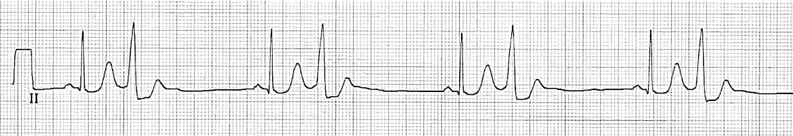 Premature Ventricular Complex (PVC) bigeminy